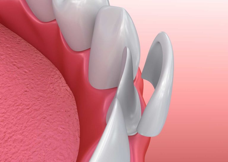 What Are Dental Veneers? | Dental Veneers near me