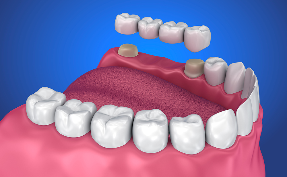 What Is a Dental Bridge?