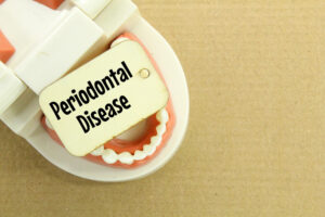 Understanding Periodontal Disease And Its Cure High Street