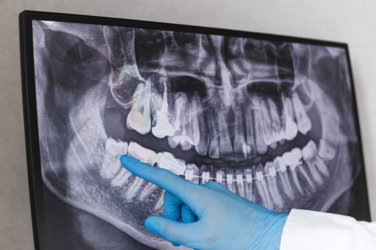 X-ray result of teeth