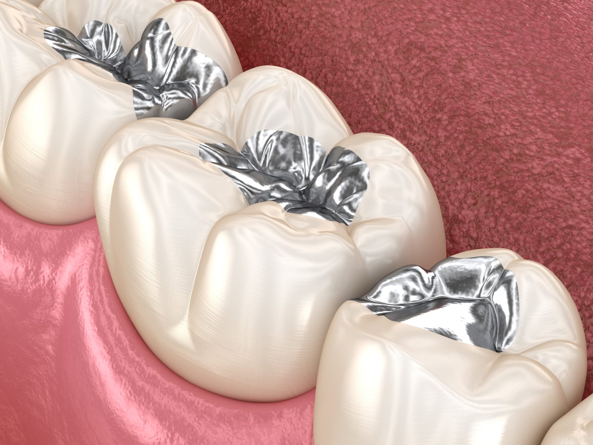 Should I Have My Silver Fillings Replaced? High Street