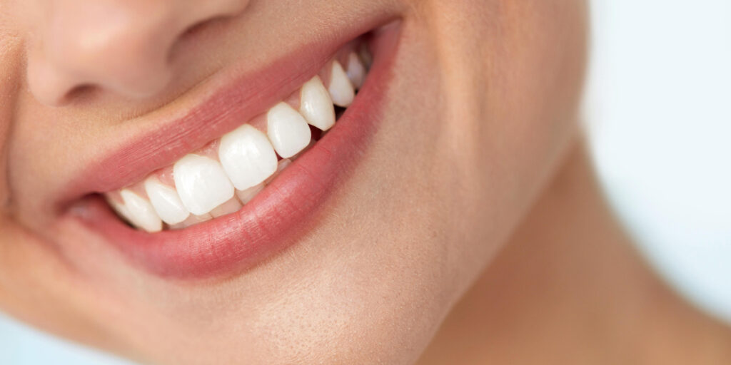 Cosmetic Bonding or Veneers teeth